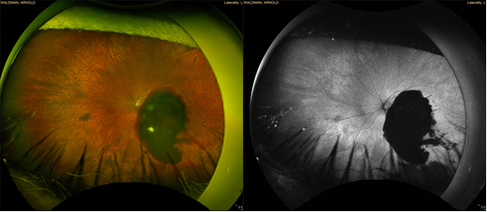 Image of the Month: February 2024 - Submacular Hemorrhage | Leading ...